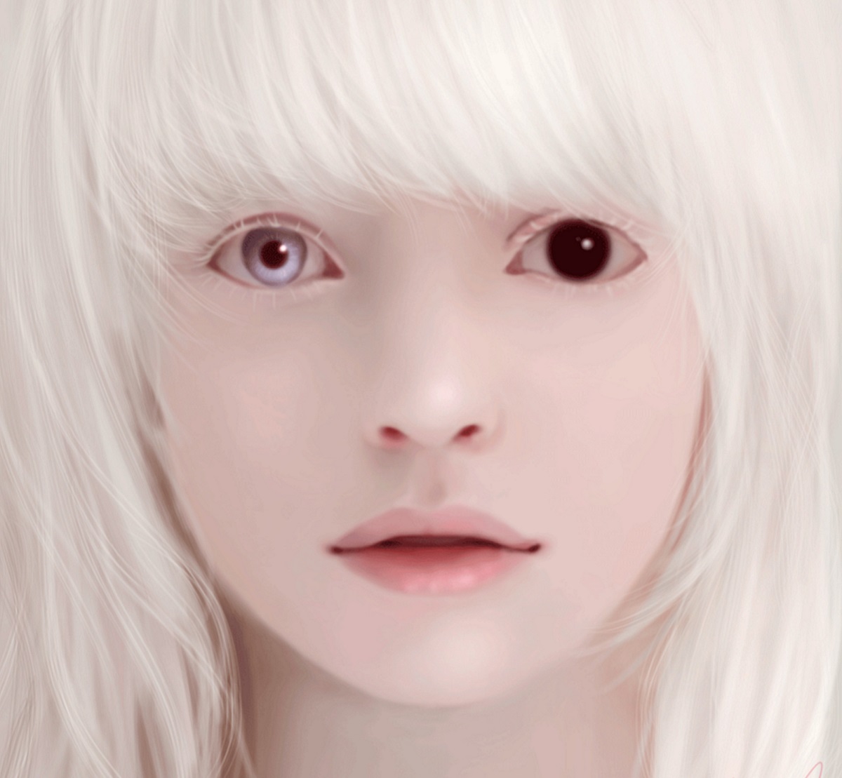 Глазокожный альбинизм