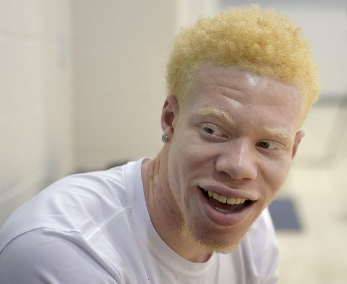 Альбинос негроидной расы.