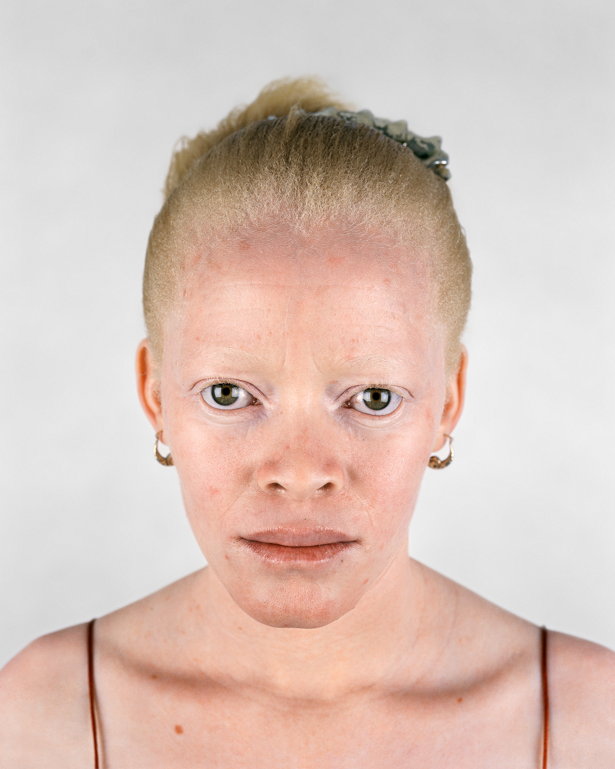 Белый негр. Альбинос негроидной расы. Негр альбинос.