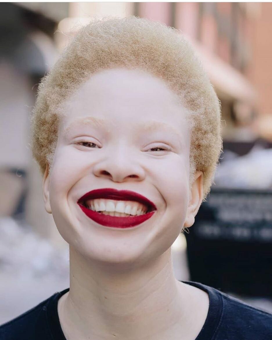 Белый негр. Негр альбинос актер. Афроамериканец альбинос. Альбинос негроидной расы.