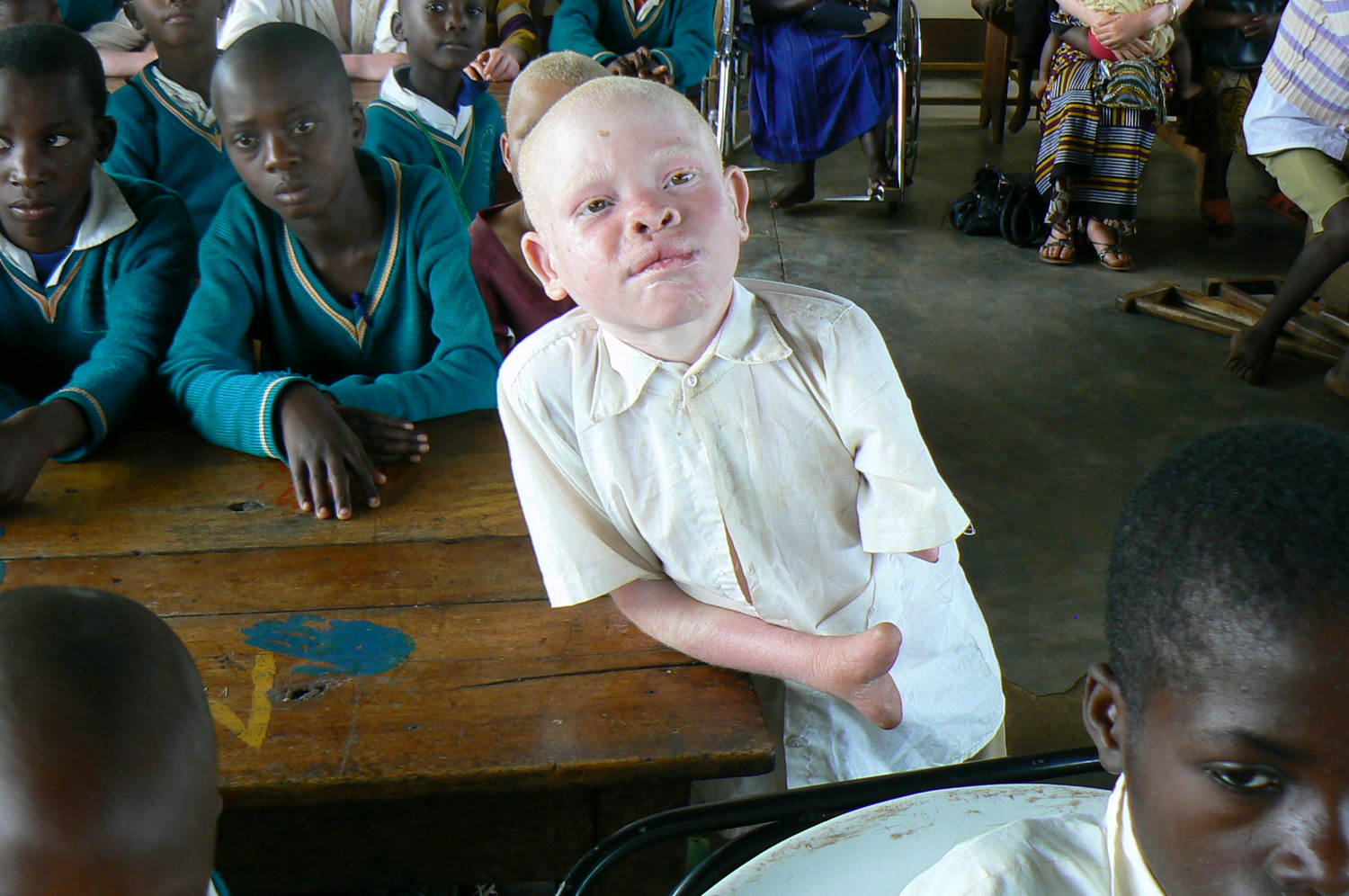 Альбиносы африканцы Танзания