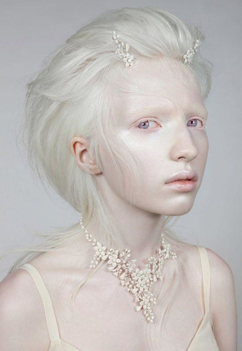 Как выглядят альбиносы люди фото