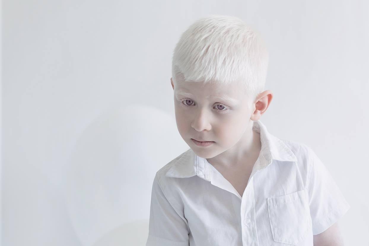 Белые люди альбиносы фото