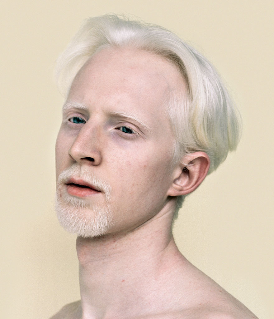 Человек с самой светлой. Шимон альбинос.