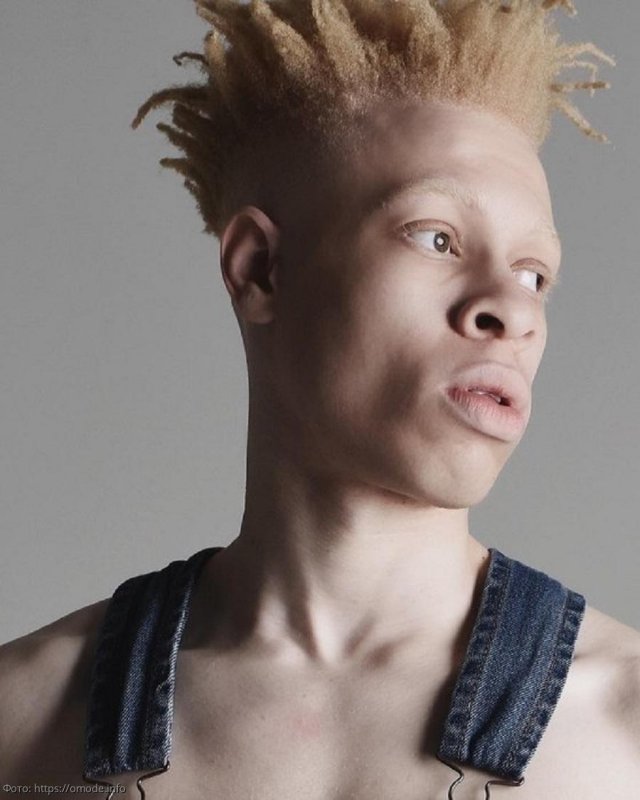 Афроамериканец альбинос Лео