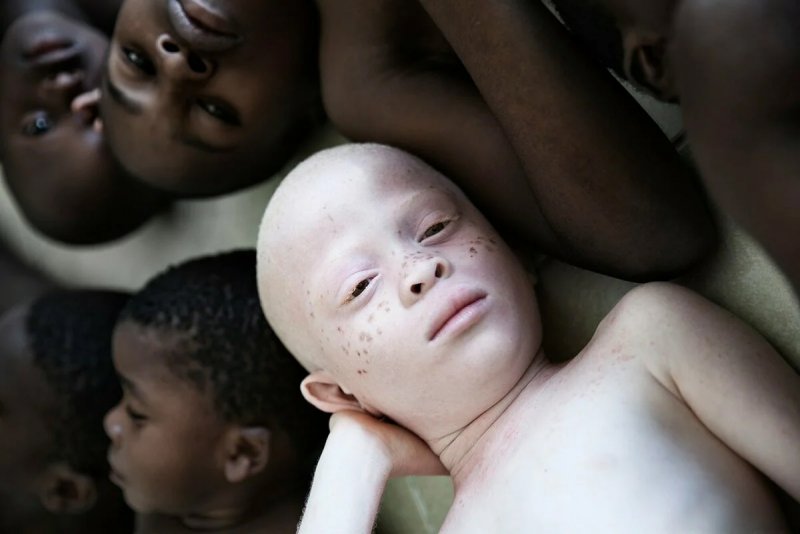 Альбиносы африканцы Танзания