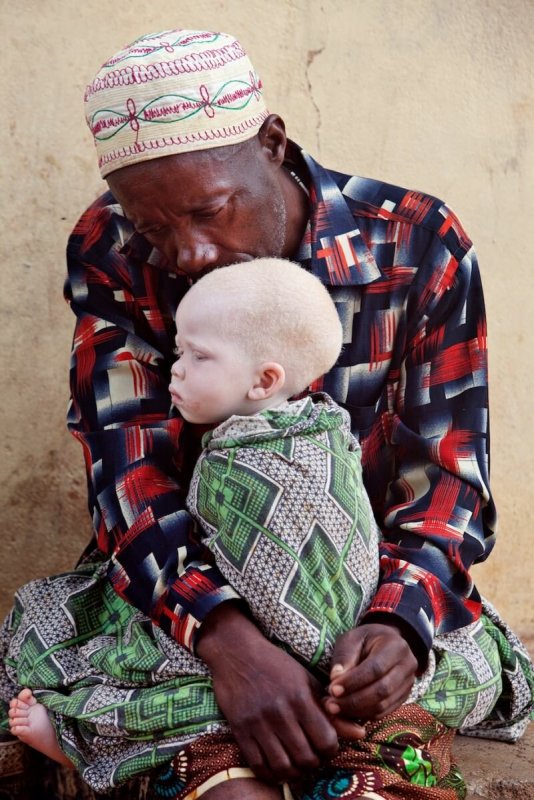 Альбиносы африканцы дети