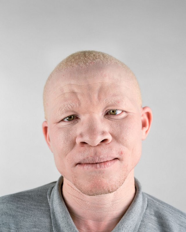 Афроамериканец альбинос