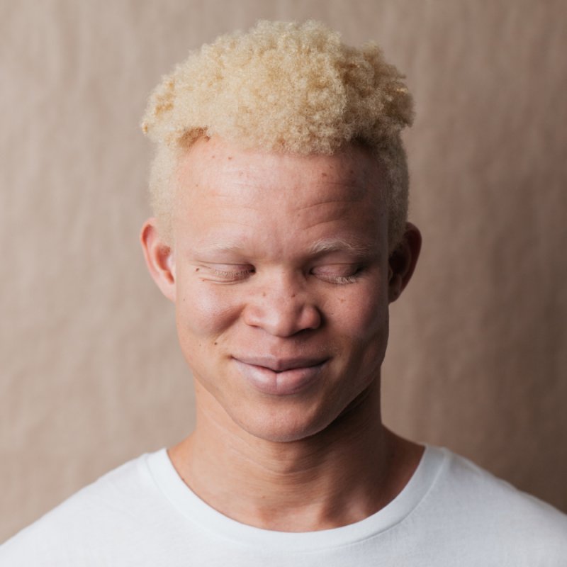 Альбинос негроидной расы