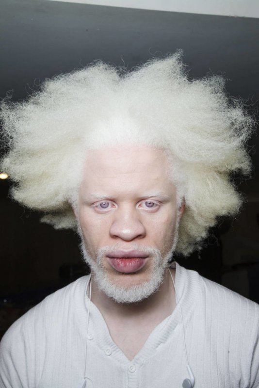 Афроамериканец альбинос.