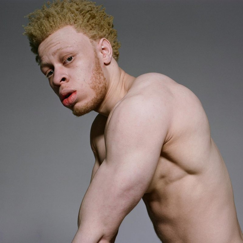Альбинос негроидной расы