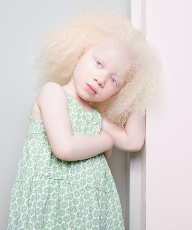 Альбинизм клазно кожный