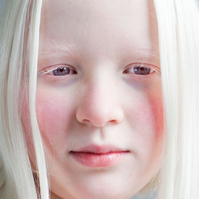 Глазно-кожный альбинизм