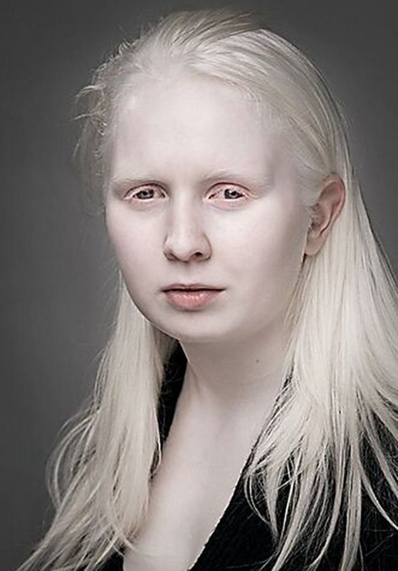 Глазно-кожный альбинизм