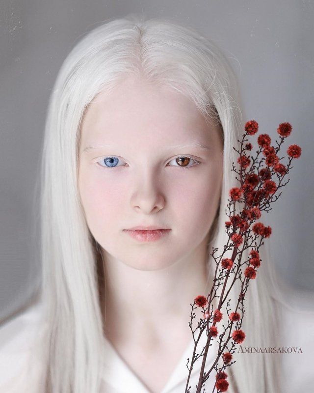 Амина Арчакова альбинос