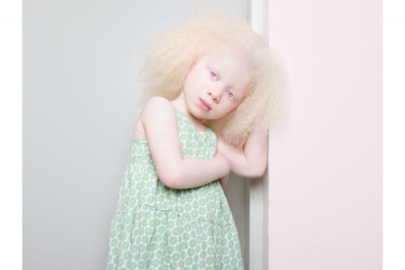 Девочка альбинос подросток