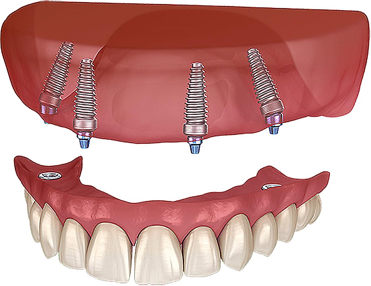Имплантация зубов all on 6. Имплантация зубов по технологии «all on 4».