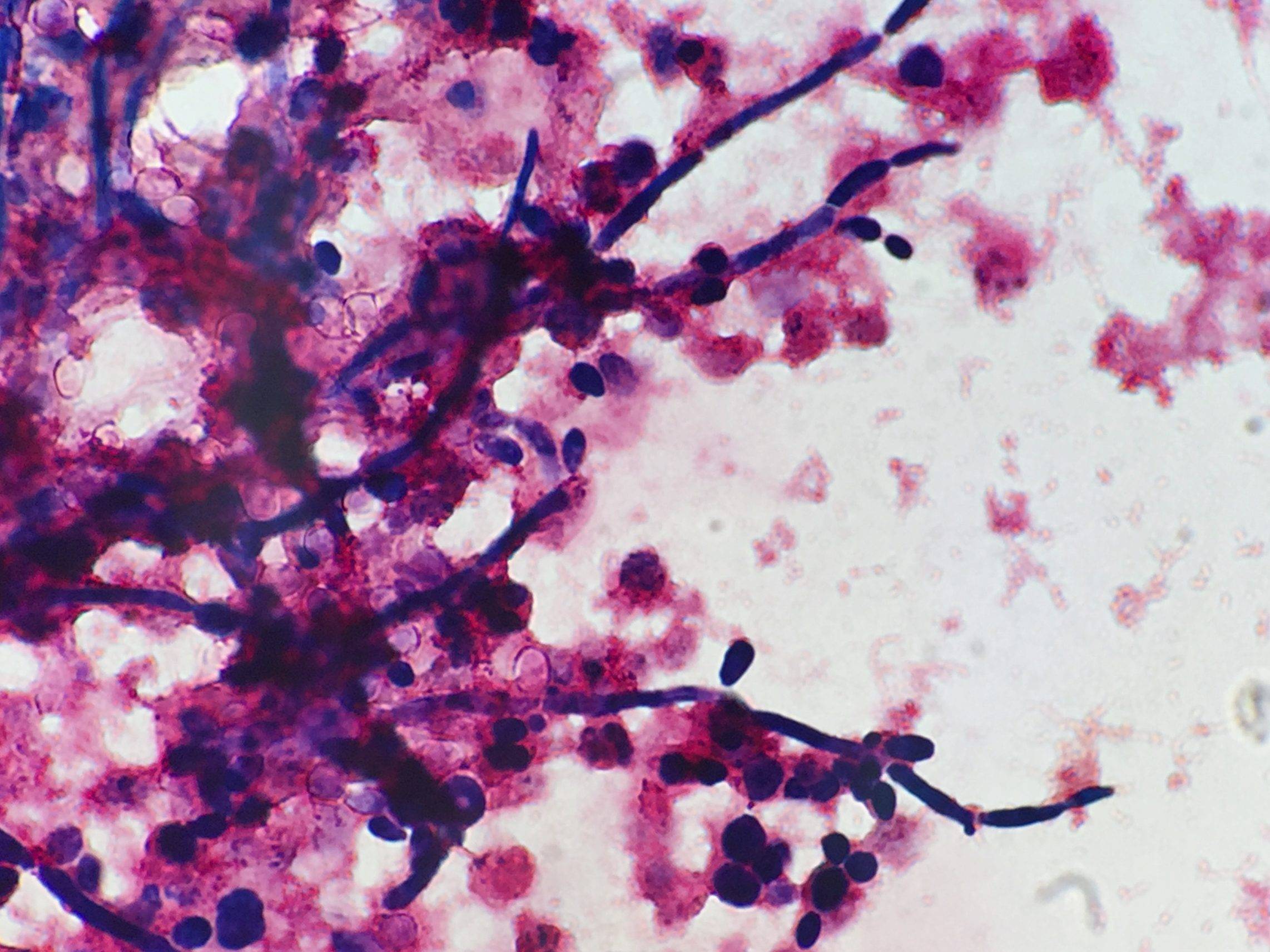 Молочница гриб. Кандида альбиканс под микроскопом. Грибы кандида микроскопия.