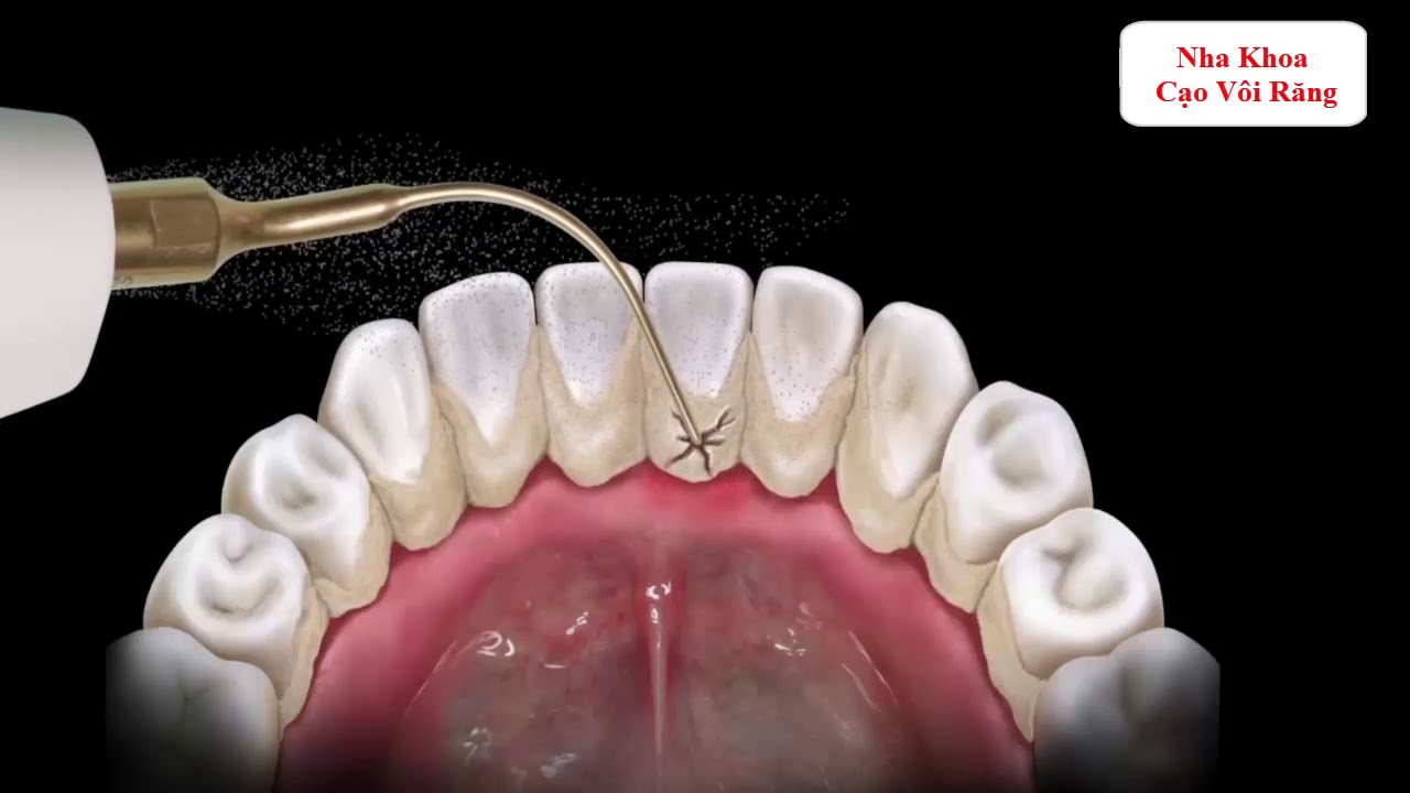Ультразвуковое удаление наддесневых и поддесневых зубных отложений