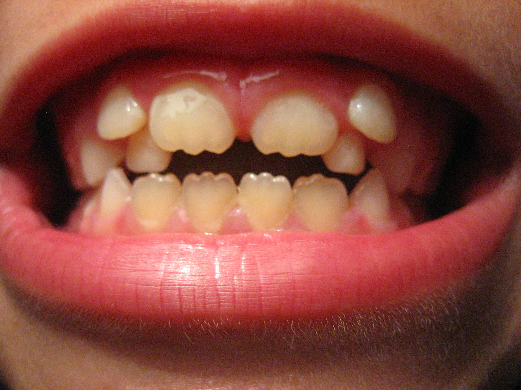 зубы резцы где находятся фото