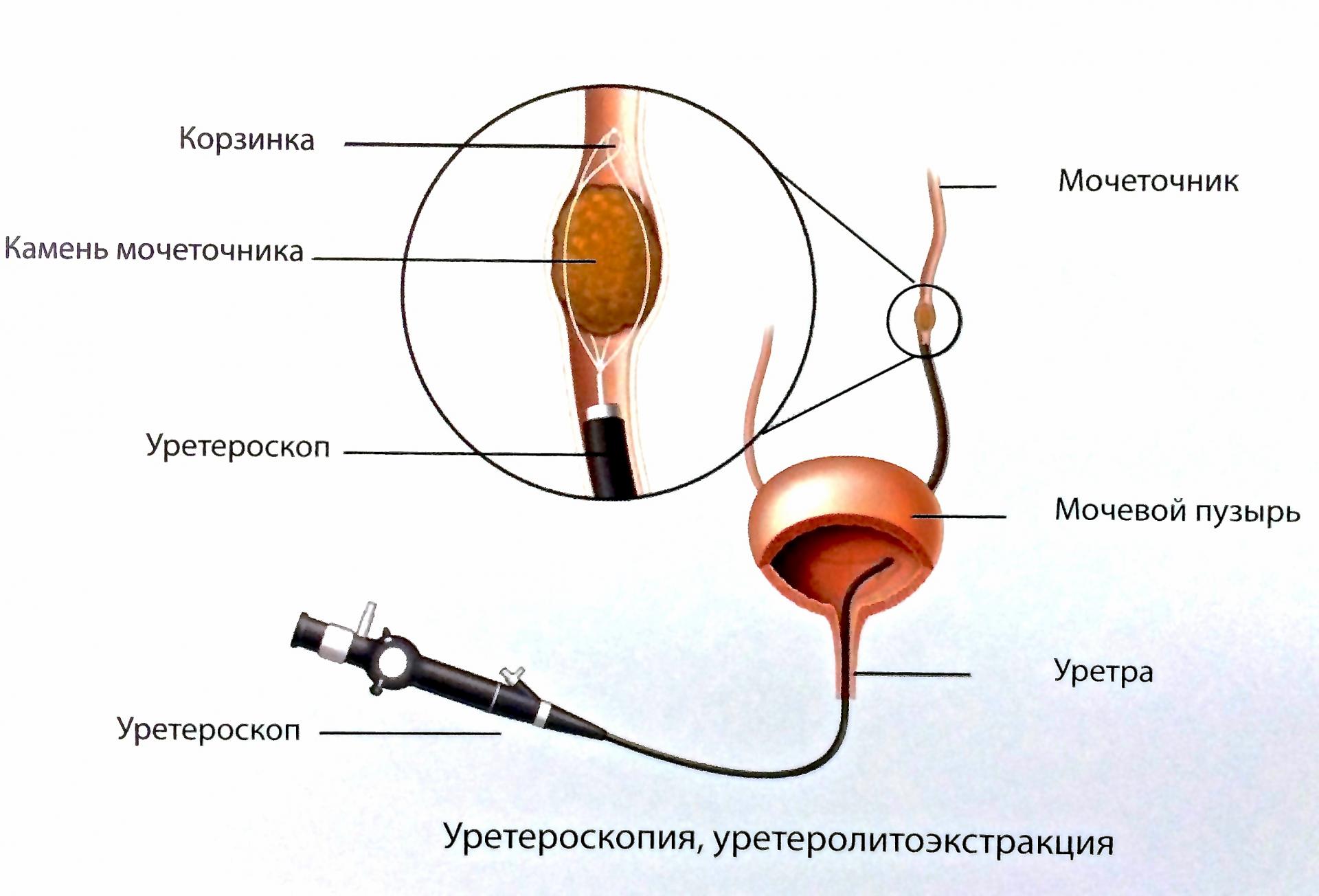 Операция на мочевом пузыре у мужчин. Урология стент в мочеточнике. Уретроскопия мочевого пузыря. Эндоскопическая литотрипсия. Эндоскопическая уретеролитотрипсия.