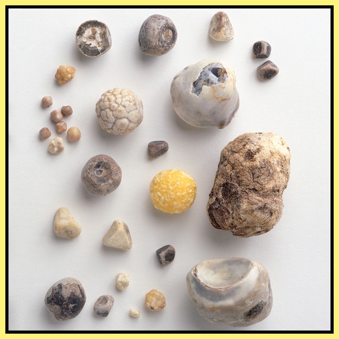 Почему выходят камни. Струвитные камни в мочевом пузыре. Известковые камни в желчном пузыре.