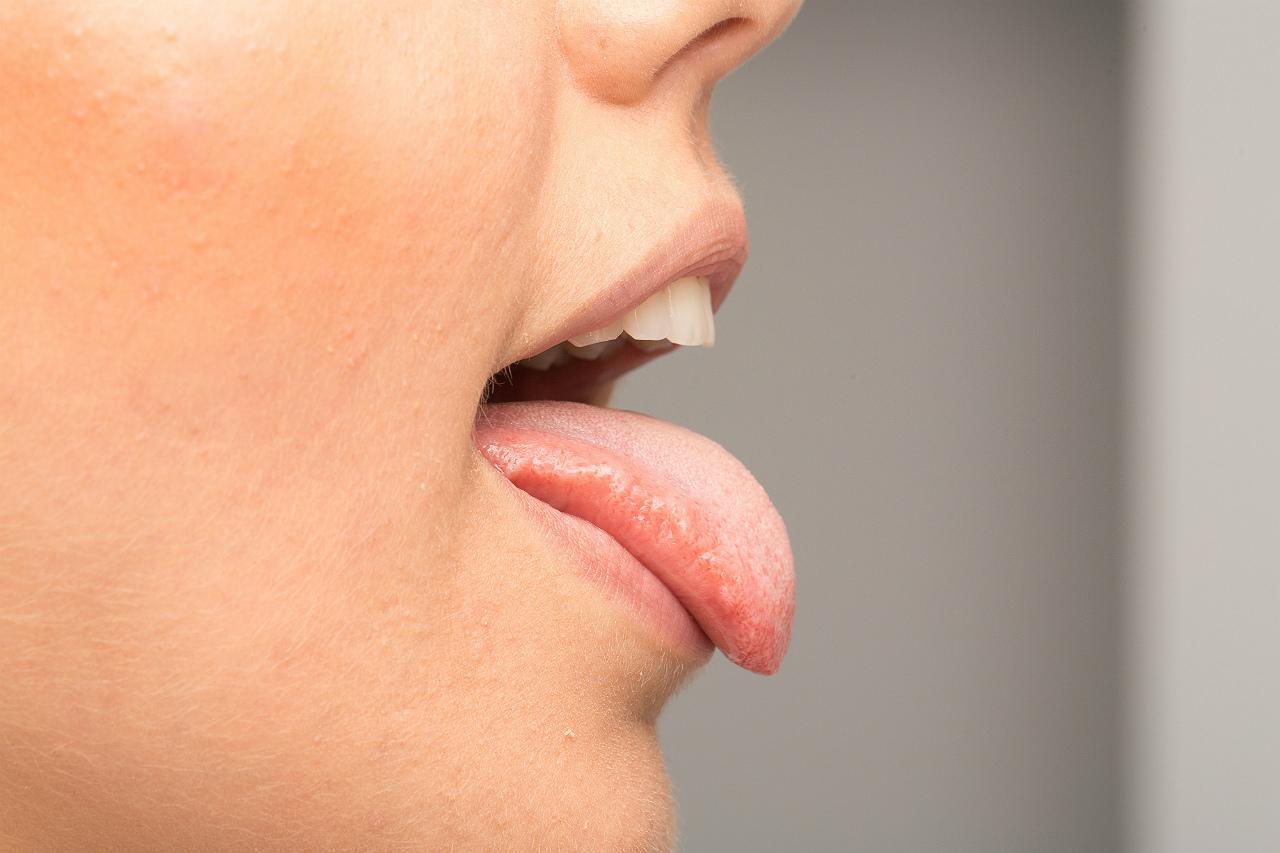 Новообразования слизистой полости рта и языка