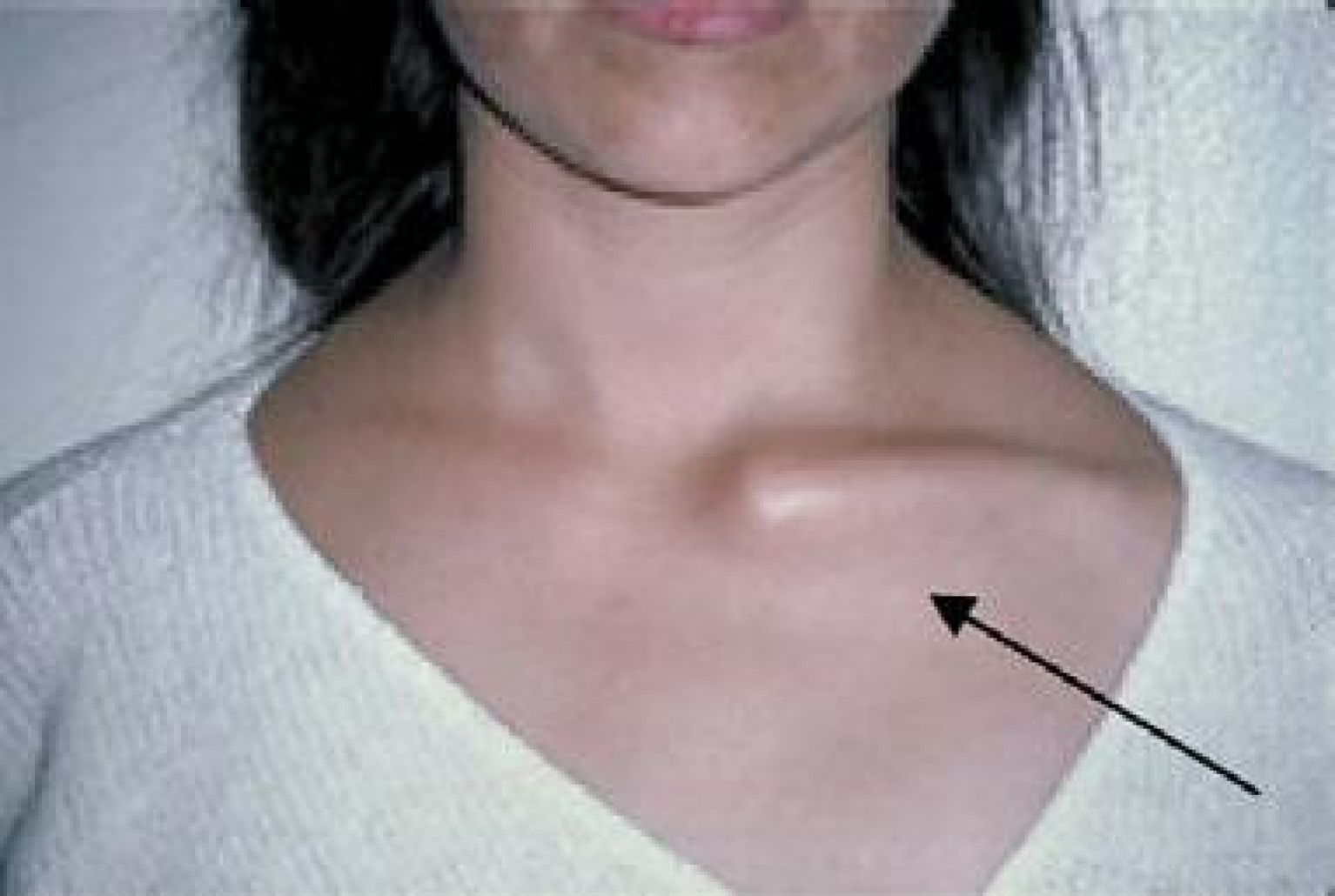 воспаление лимфоузлов на груди у женщин фото 25