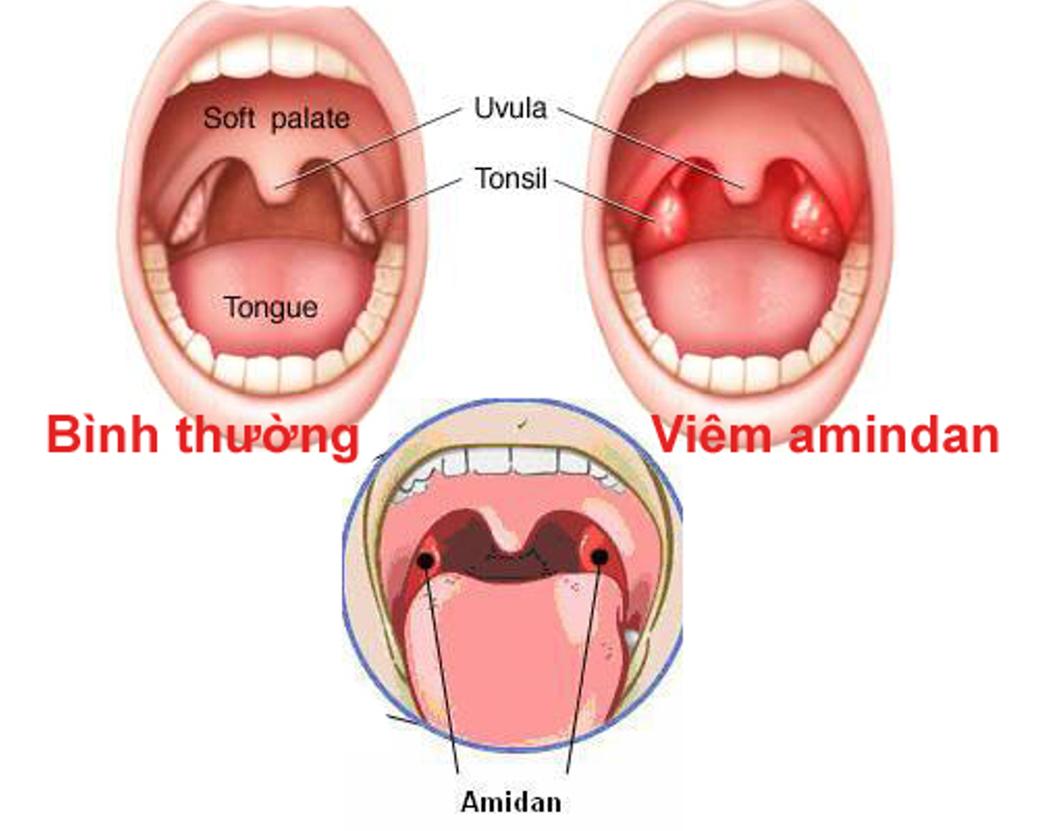 ангина симптомы фото горла